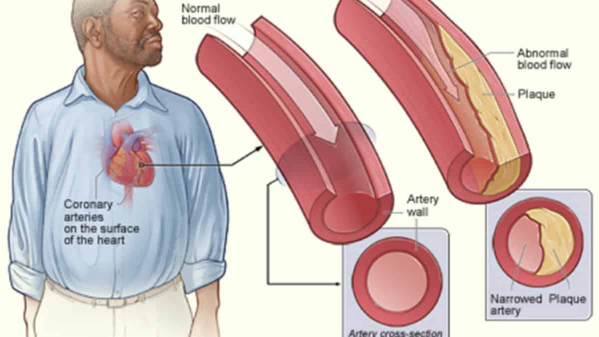 come interpretare i valori del colesterolo