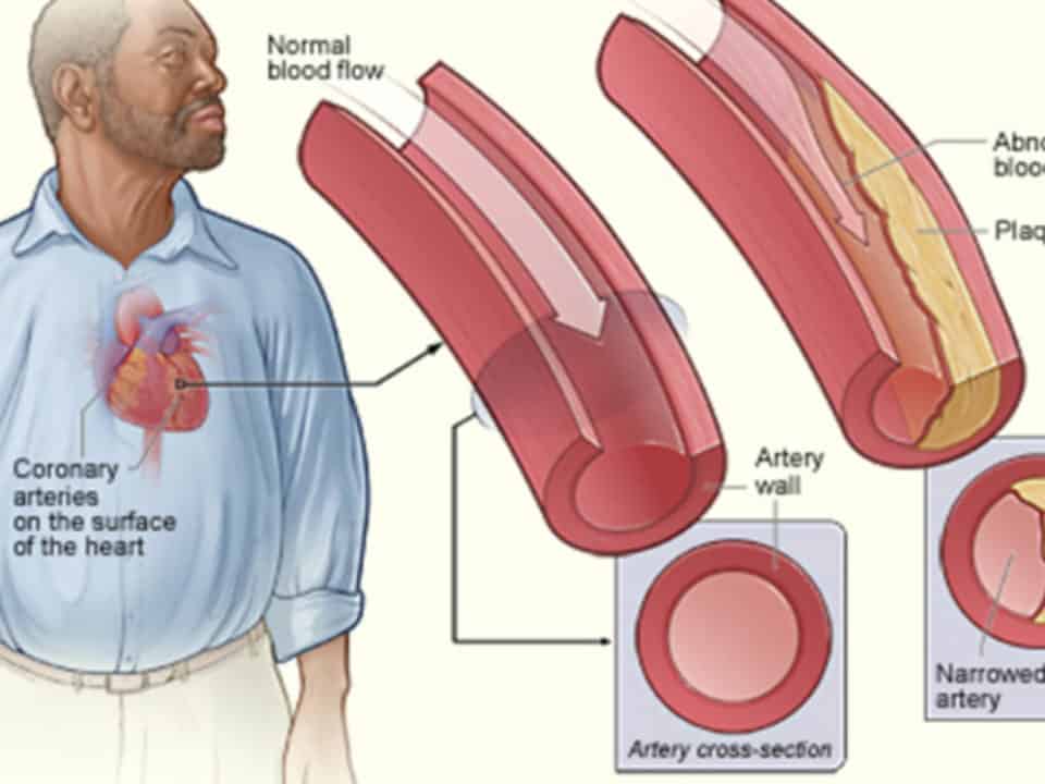 come interpretare i valori del colesterolo