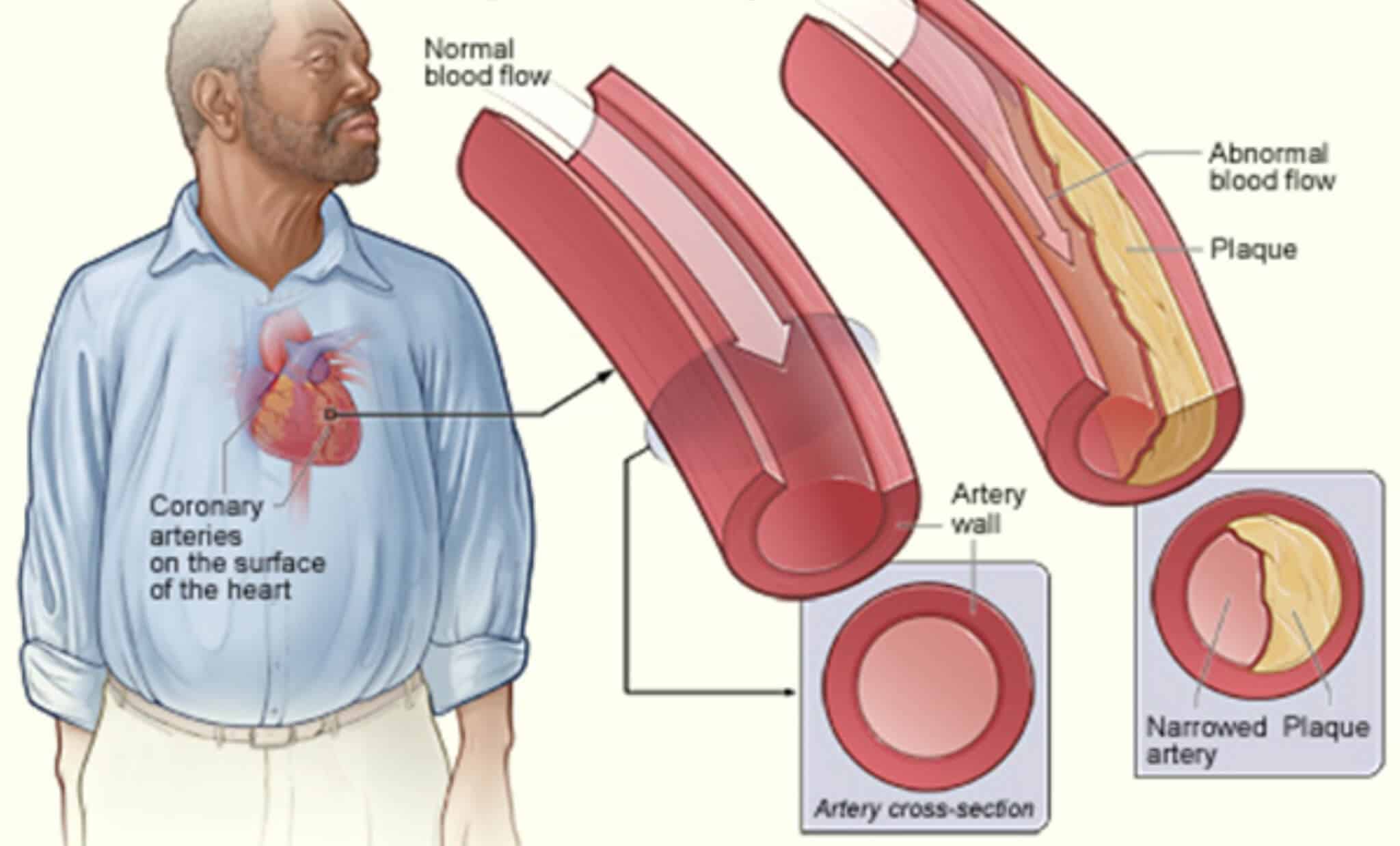 come interpretare i valori del colesterolo