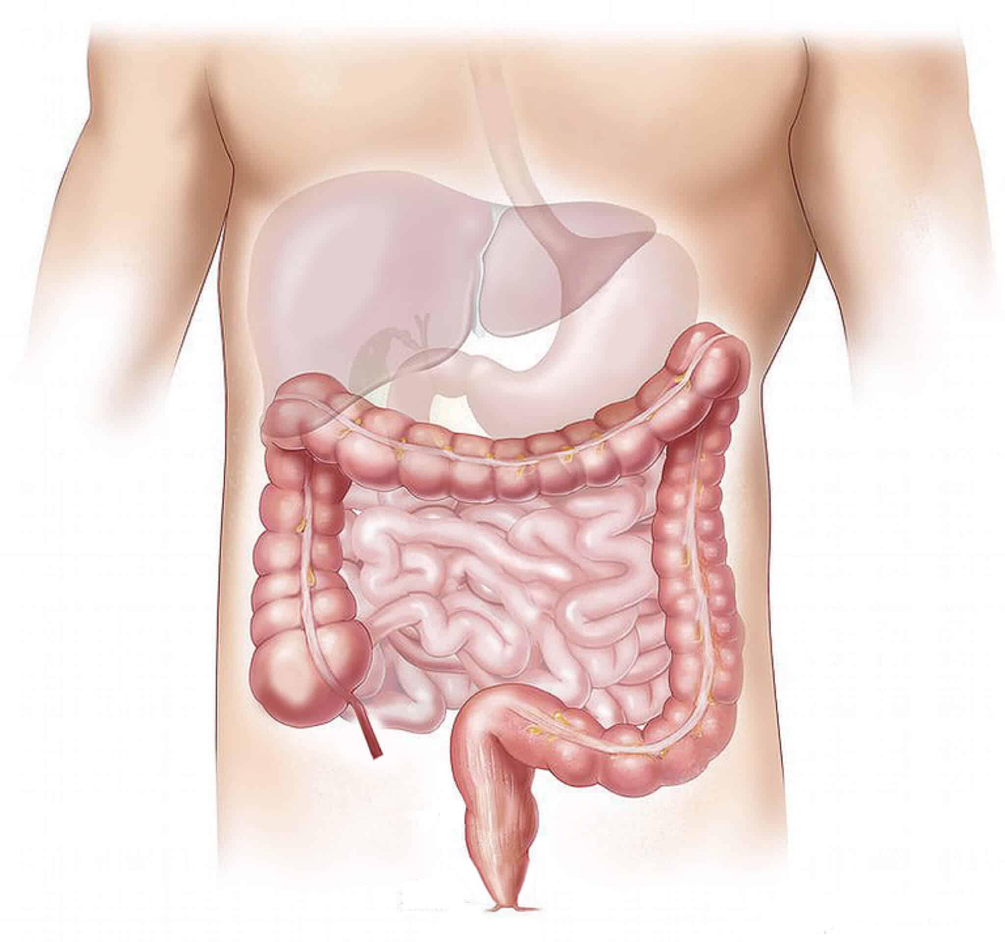 sindrome dell'intestino gocciolante