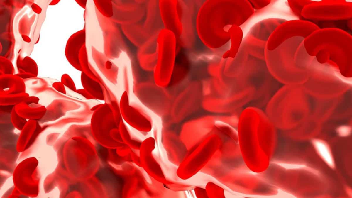 anemia megaloblastica